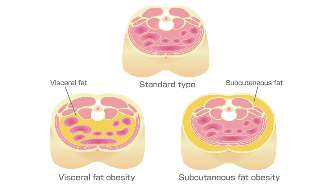 Viszerales Fett und Subkutanes Fett